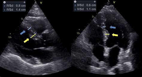 lv septal hypertrophy|what is basal septal hypertrophy.